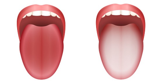 健康な舌と舌苔の比較図